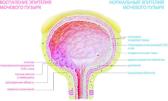 хронический цистит